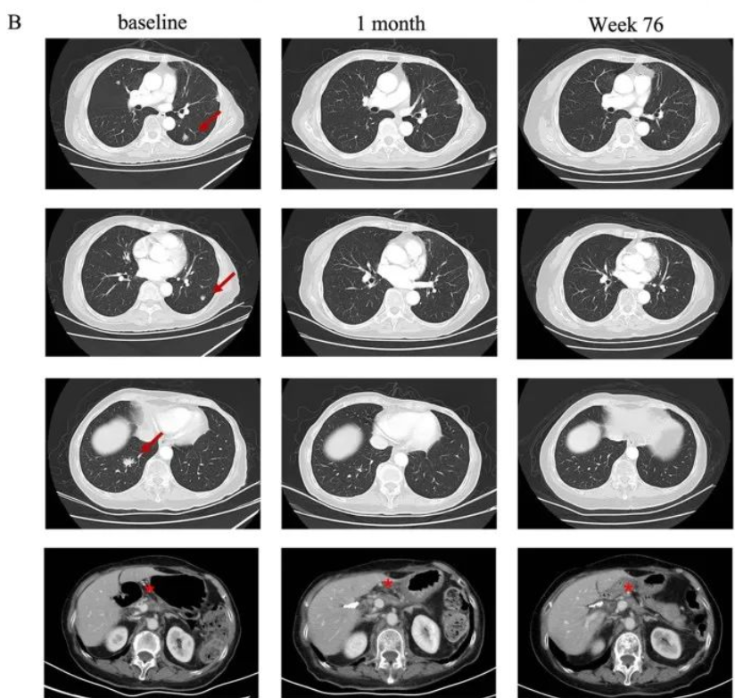 CAR-T治疗胰腺癌肺转移的效果 CAR-T治疗胰腺癌肺转移的效果