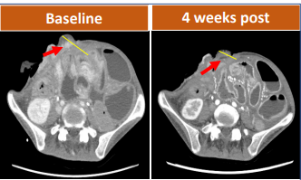 CAR-T治疗晚期胃腺癌的效果 CAR-T治疗晚期胃腺癌的效果