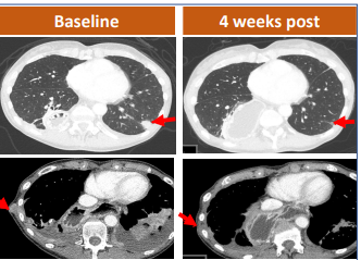 CAR-T治疗胃腺癌肺转移的效果 CAR-T治疗胃腺癌肺转移的效果