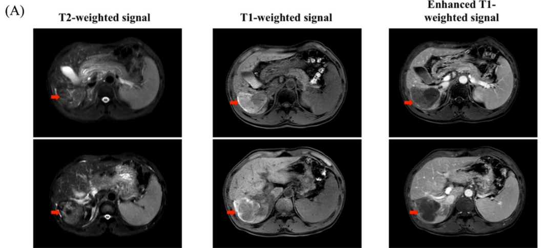 CAR-T疗法治疗肝细胞癌的效果 CAR-T疗法治疗肝细胞癌的效果