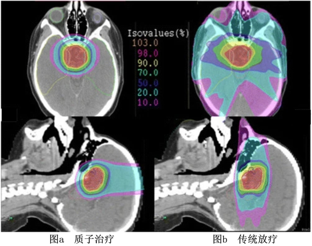 颅咽管瘤质子治疗和调强放疗对比