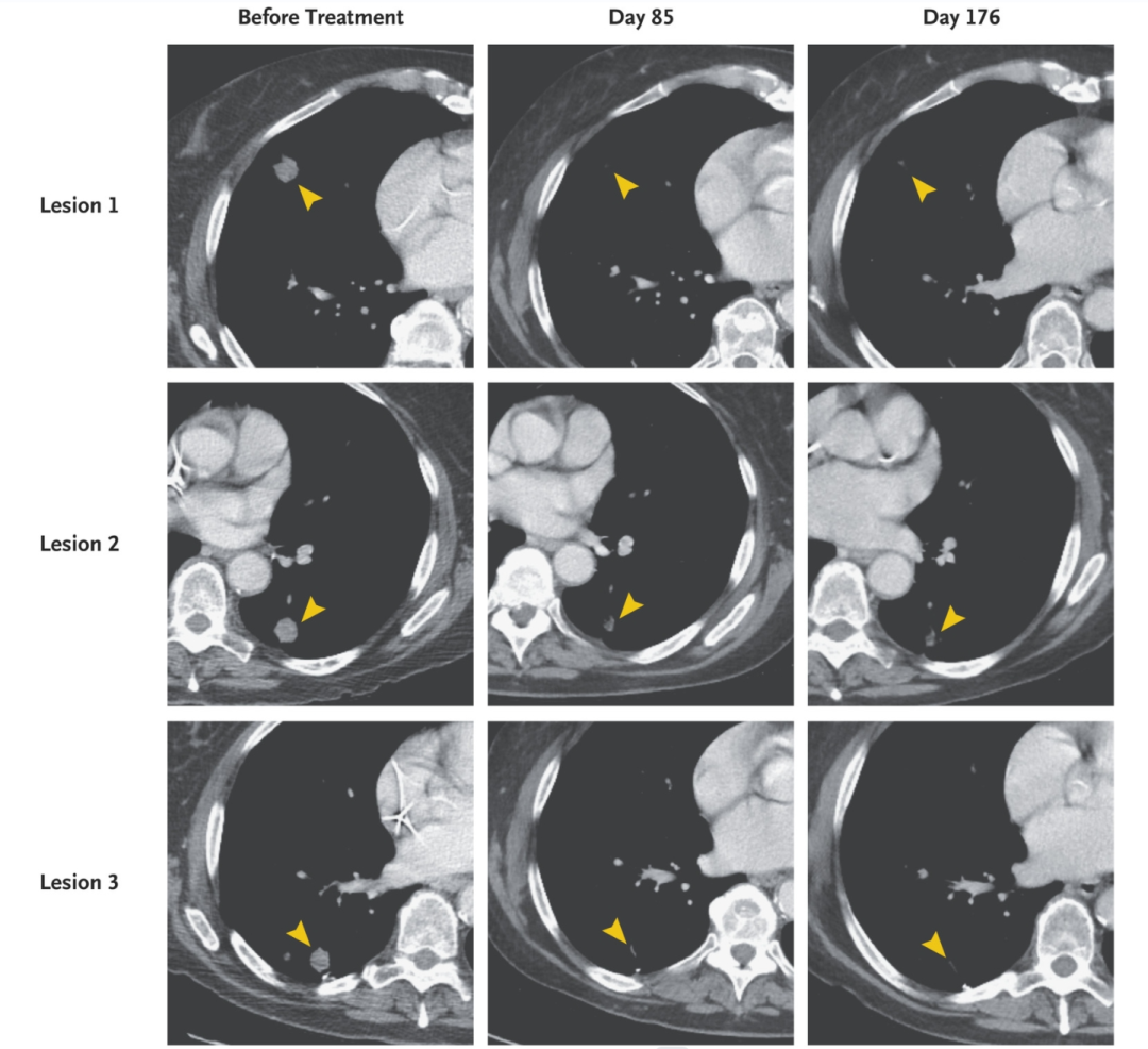靶向KRASG12D的TCR-T细胞疗法治疗胰腺癌的效果 靶向KRASG12D的TCR-T细胞疗法治疗胰腺癌的效果