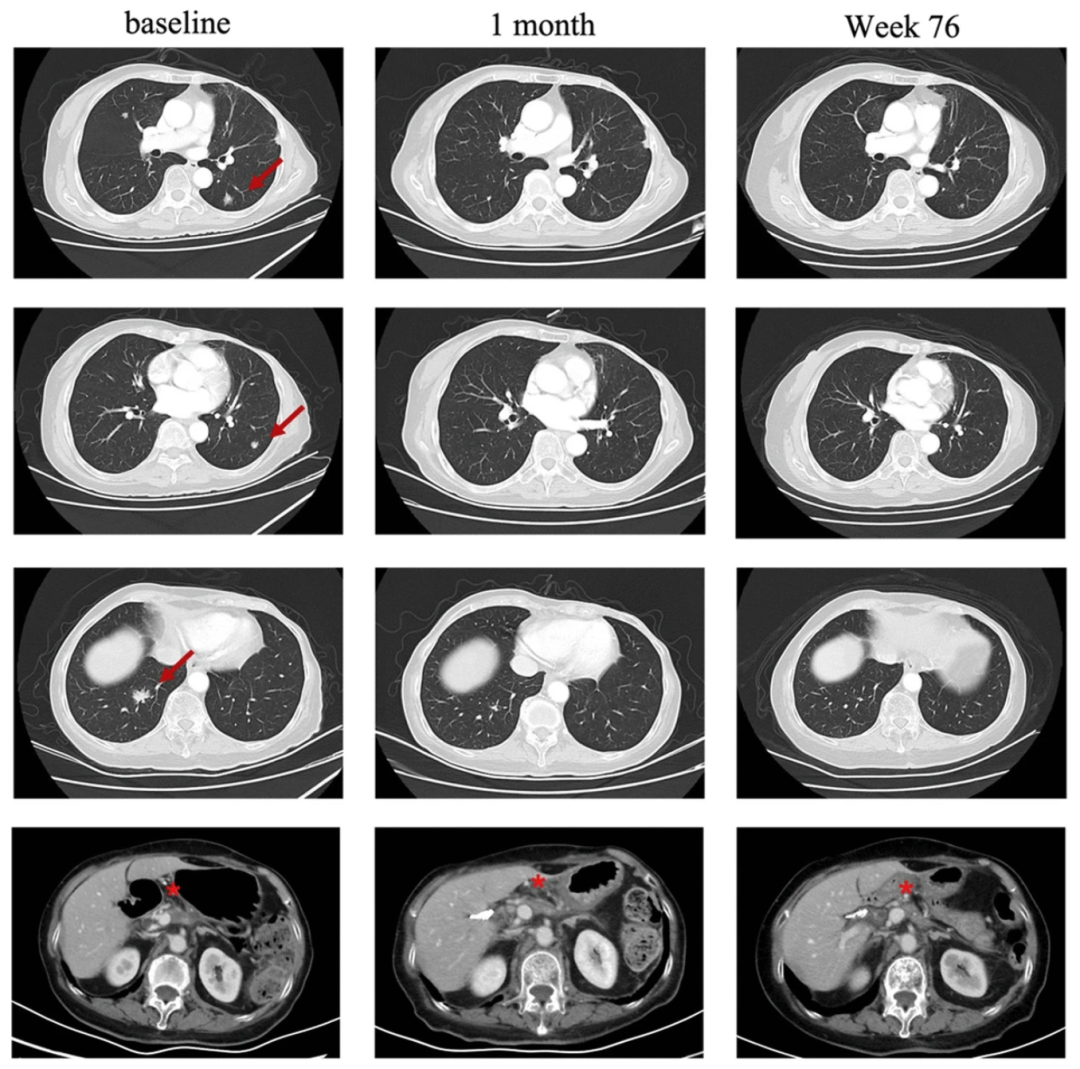 CT041治疗效果 CT041治疗效果
