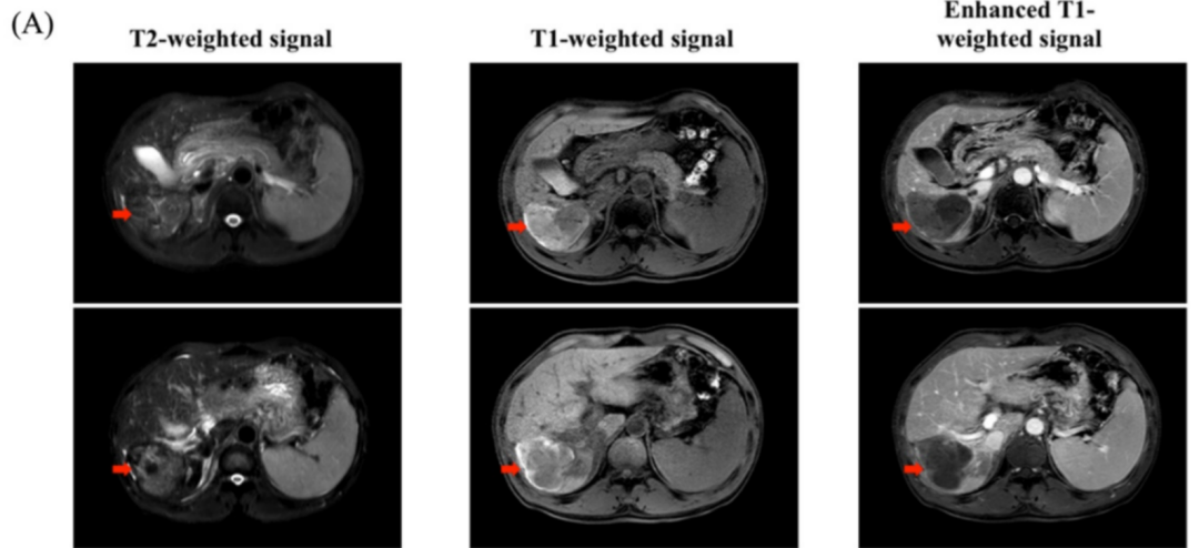 CAR-GPC3 T细胞治疗肝细胞癌的效果 CAR-GPC3 T细胞治疗肝细胞癌的效果