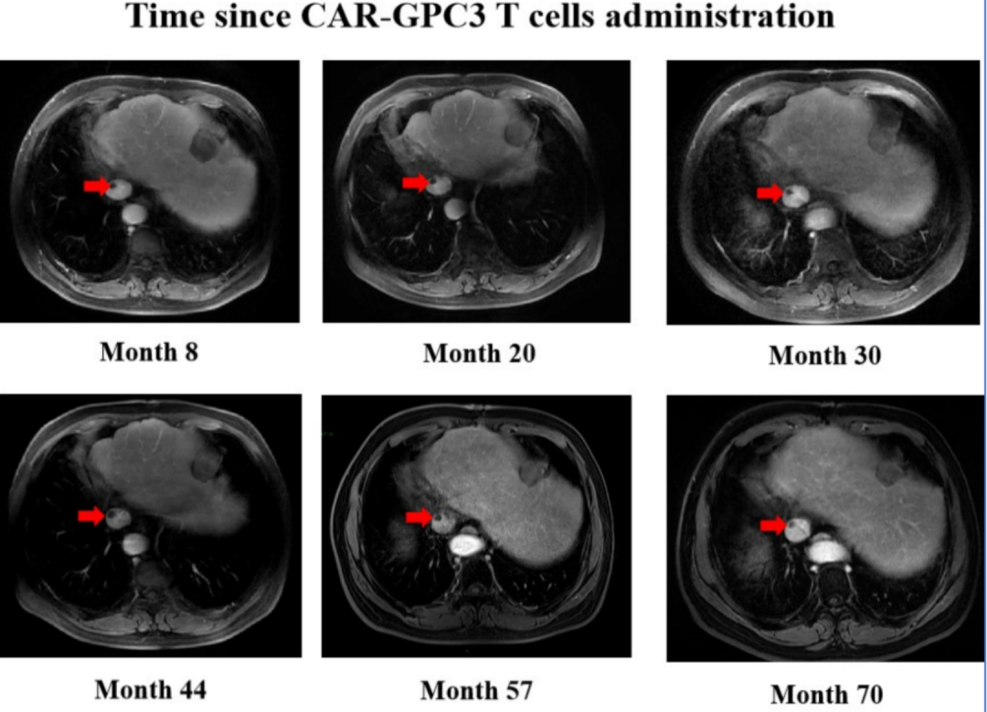 CAR-GPC3 T细胞治疗干细胞癌转移的效果 CAR-GPC3 T细胞治疗干细胞癌转移的效果