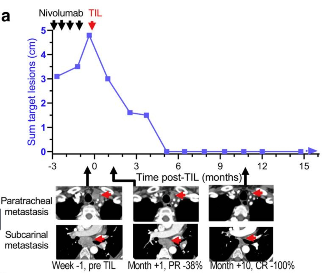 TIL细胞疗法治疗非小细胞肺癌的数据