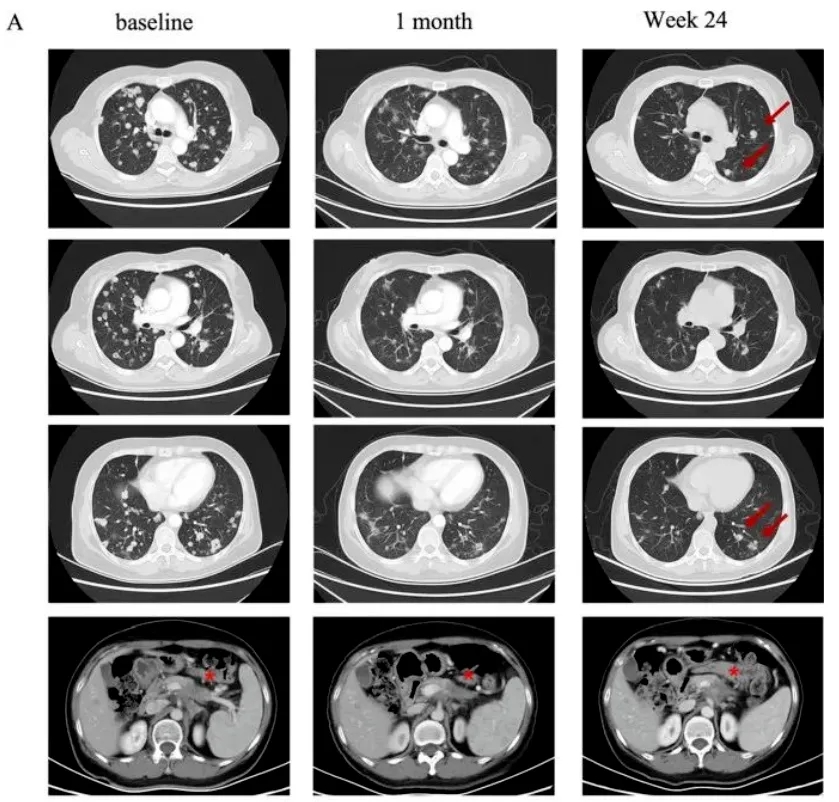 CT041治疗胰腺癌的效果 CT041治疗胰腺癌的效果