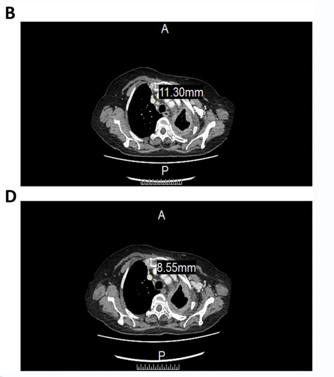 CCCR-NK92治疗晚期非小细胞肺癌淋巴结的效果 CCCR-NK92治疗晚期非小细胞肺癌淋巴结的效果