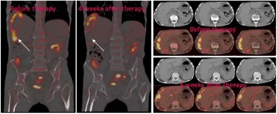 NKG2D CAR-NK细胞治疗转移性结肠癌的效果 NKG2D CAR-NK细胞治疗转移性结肠癌的效果