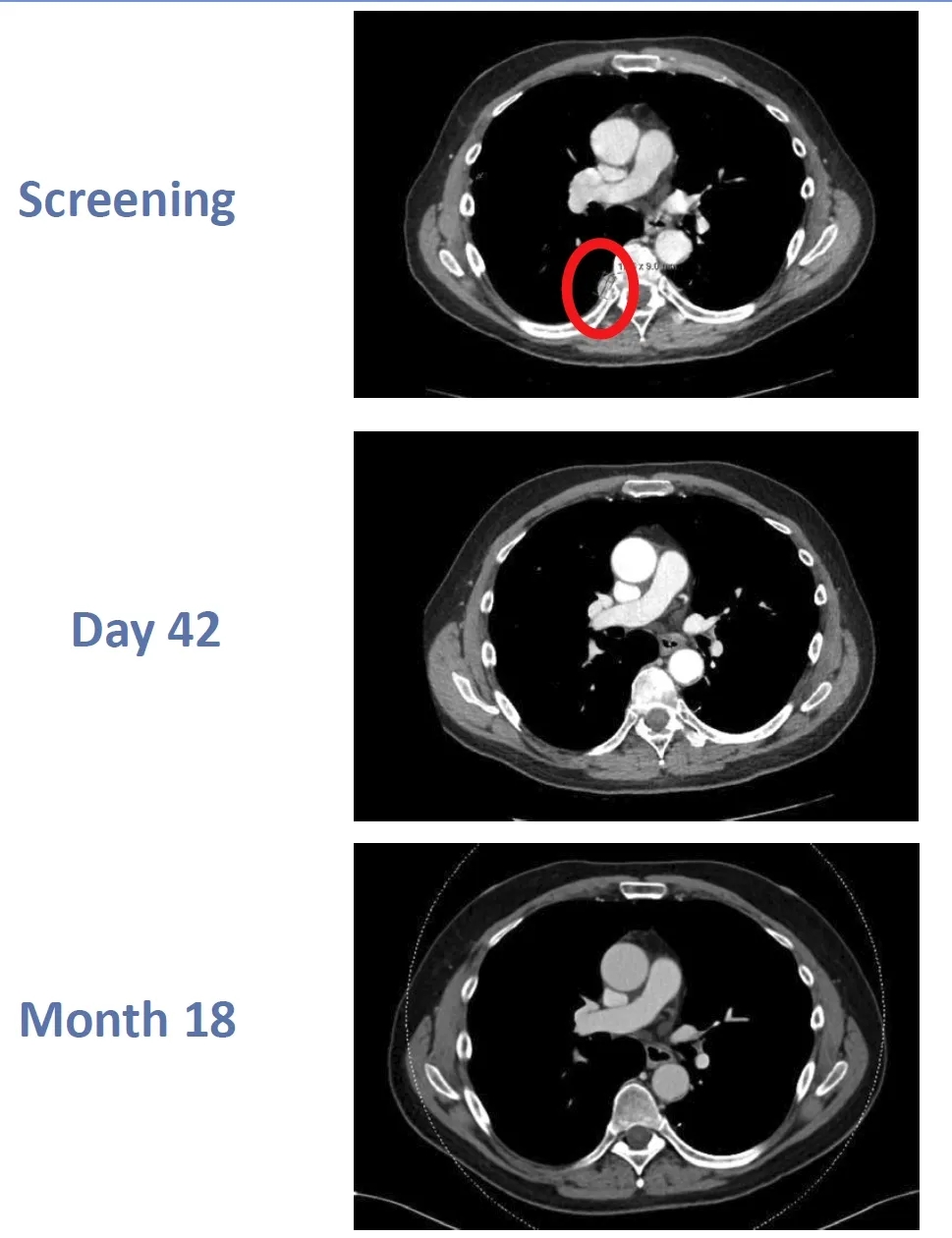 CTX130治疗肾癌的效果 CTX130治疗肾癌的效果
