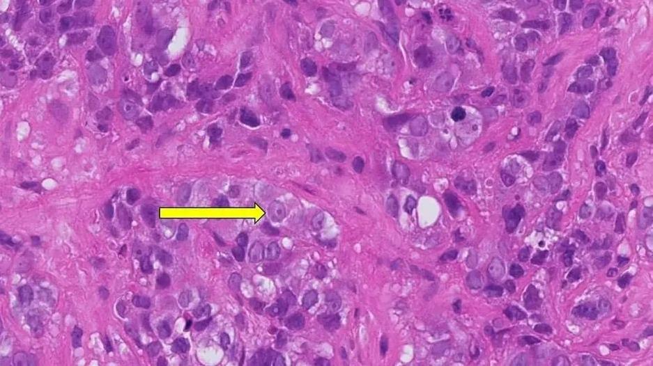 无TIL细胞患者的肿瘤组织病理切片分析