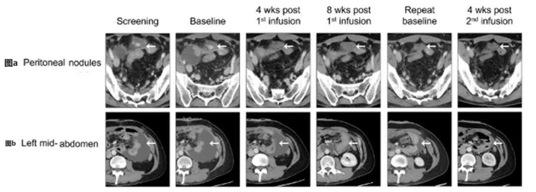 CT041治疗晚期胃癌:肿瘤病灶及腹水均改善