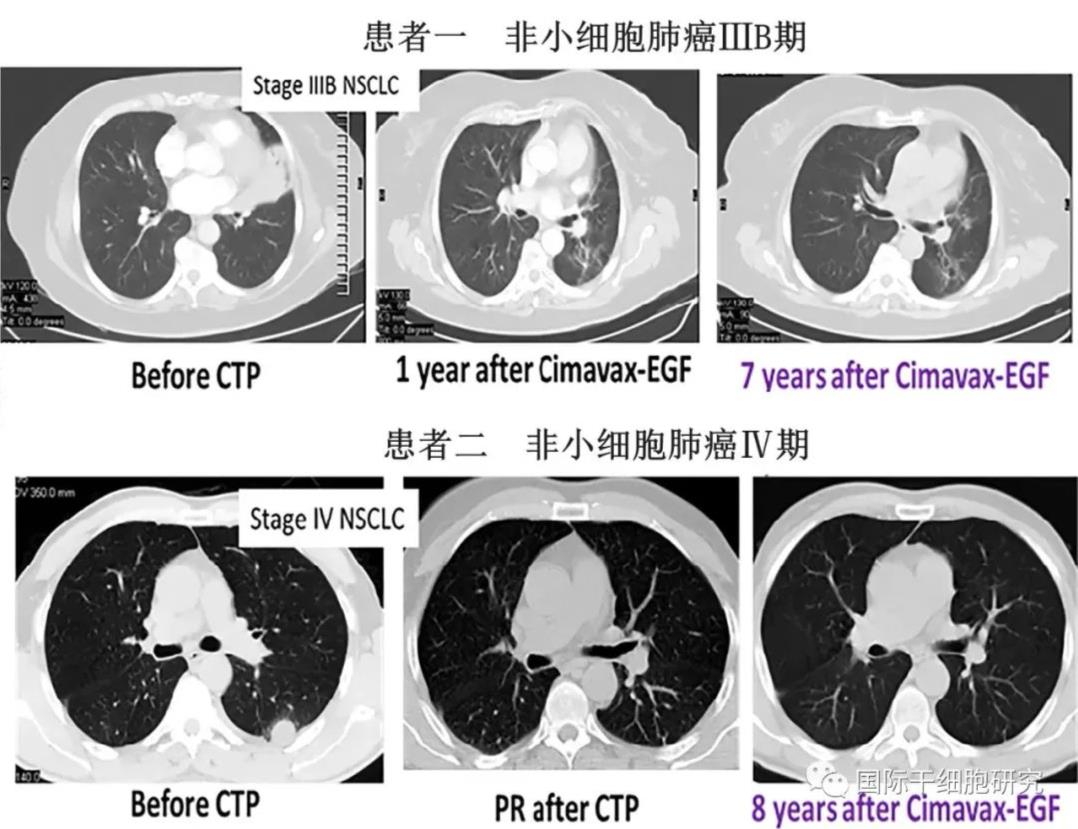 多款肿瘤疫苗相继问世,打破实体瘤治疗困境