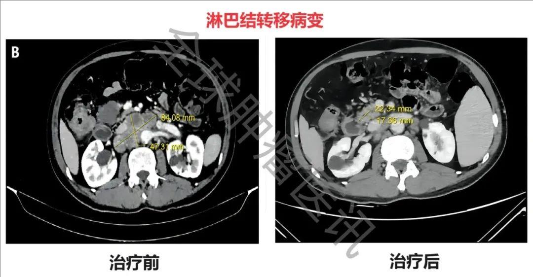 肠道菌群治疗结肠癌淋巴结转移的效果