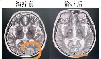 PD-1Ab21-CD19 CART细胞疗法治疗复发性白血病脑部肿瘤的效果