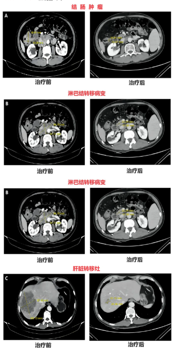 肠道菌群治疗效果