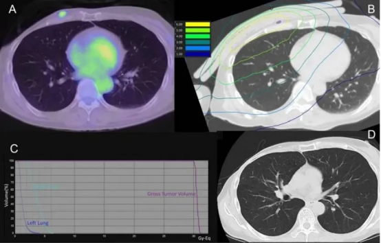 硼中子治疗左侧乳腺癌的效果 硼中子治疗左侧乳腺癌的效果