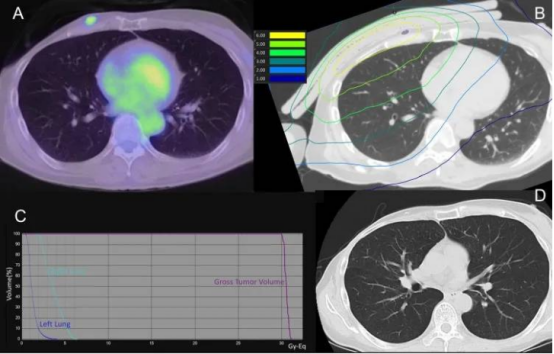 硼中子治疗乳腺癌肺部的辐射剂量分布 硼中子治疗乳腺癌肺部的辐射剂量分布