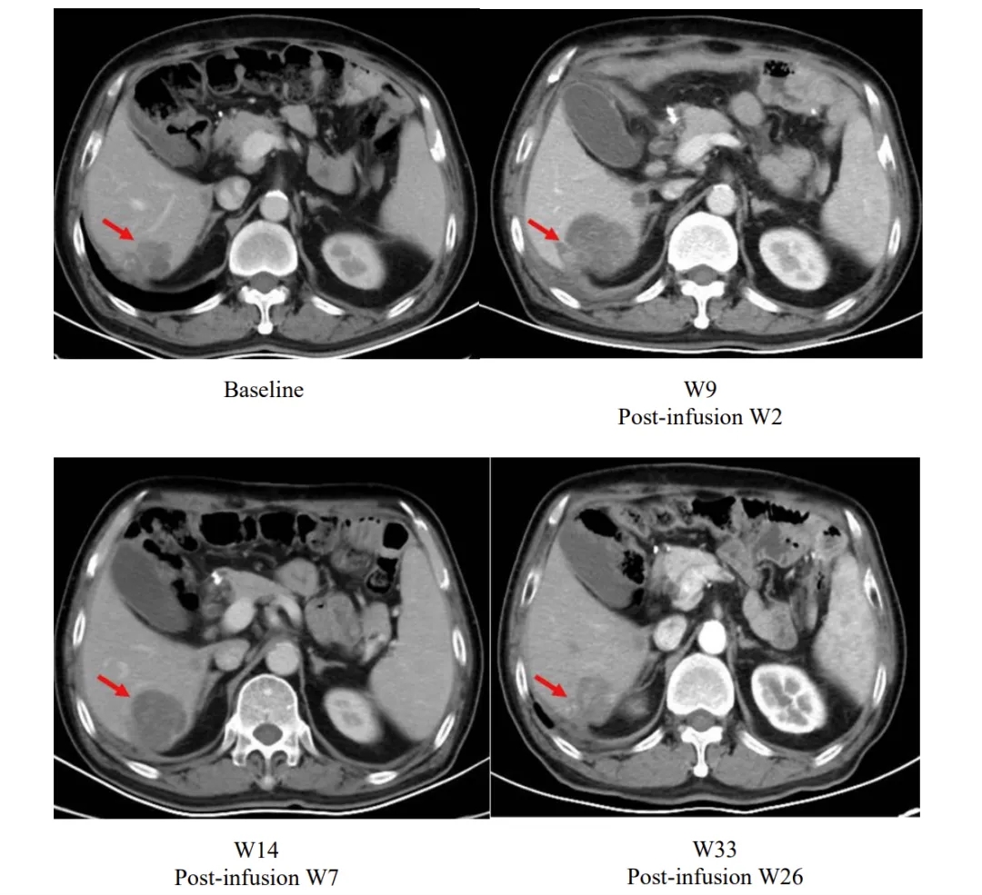 舒瑞基奥仑赛治疗效果