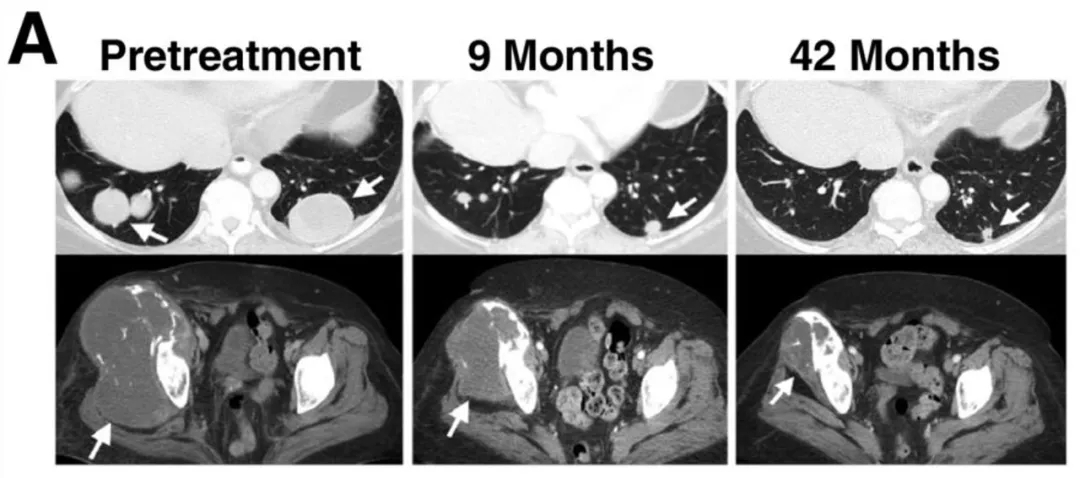 NY-ESO-1治疗效果