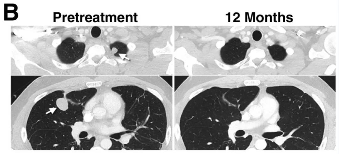 NY-ESO-1治疗效果