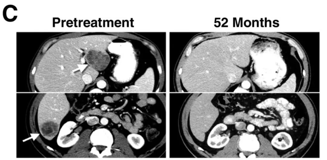 NY-ESO-1治疗黑色素瘤转移的效果