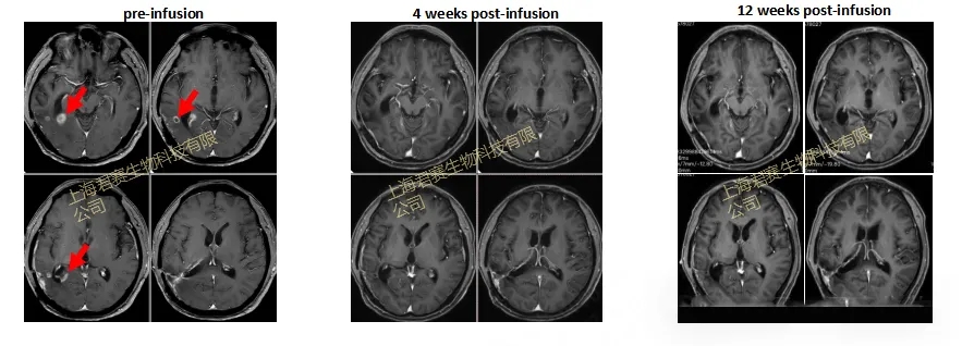 GC101治疗脑胶质瘤的效果