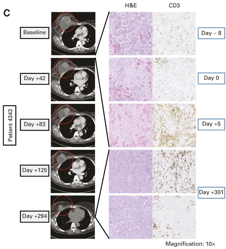 TIL细胞疗法治疗乳腺癌的效果