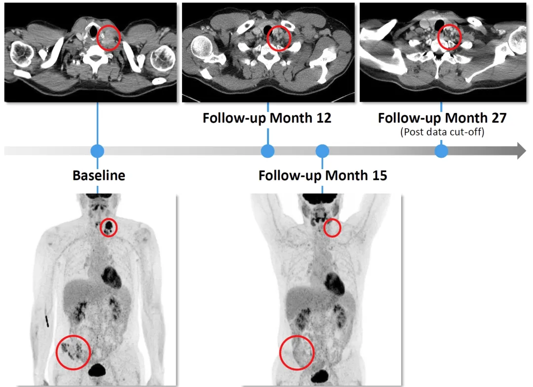 IMA203治疗黑色素瘤的效果