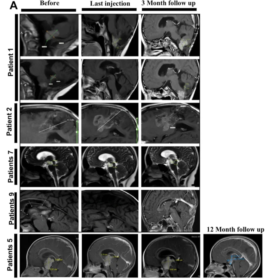 NK细胞疗法治疗儿童胶质瘤的效果