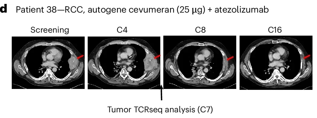 BNT211治疗肾癌的效果