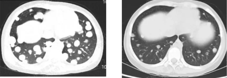 佐来曲替尼治疗效果