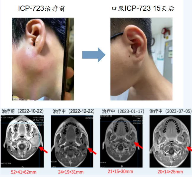 佐来曲替尼治疗涎腺肿瘤的效果