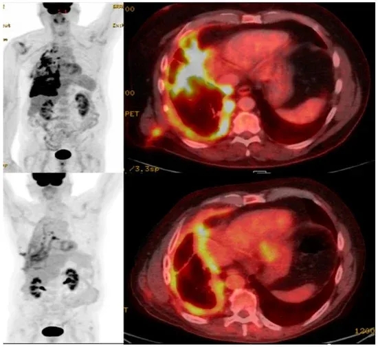 CART细胞疗法治疗非小细胞肺癌的效果