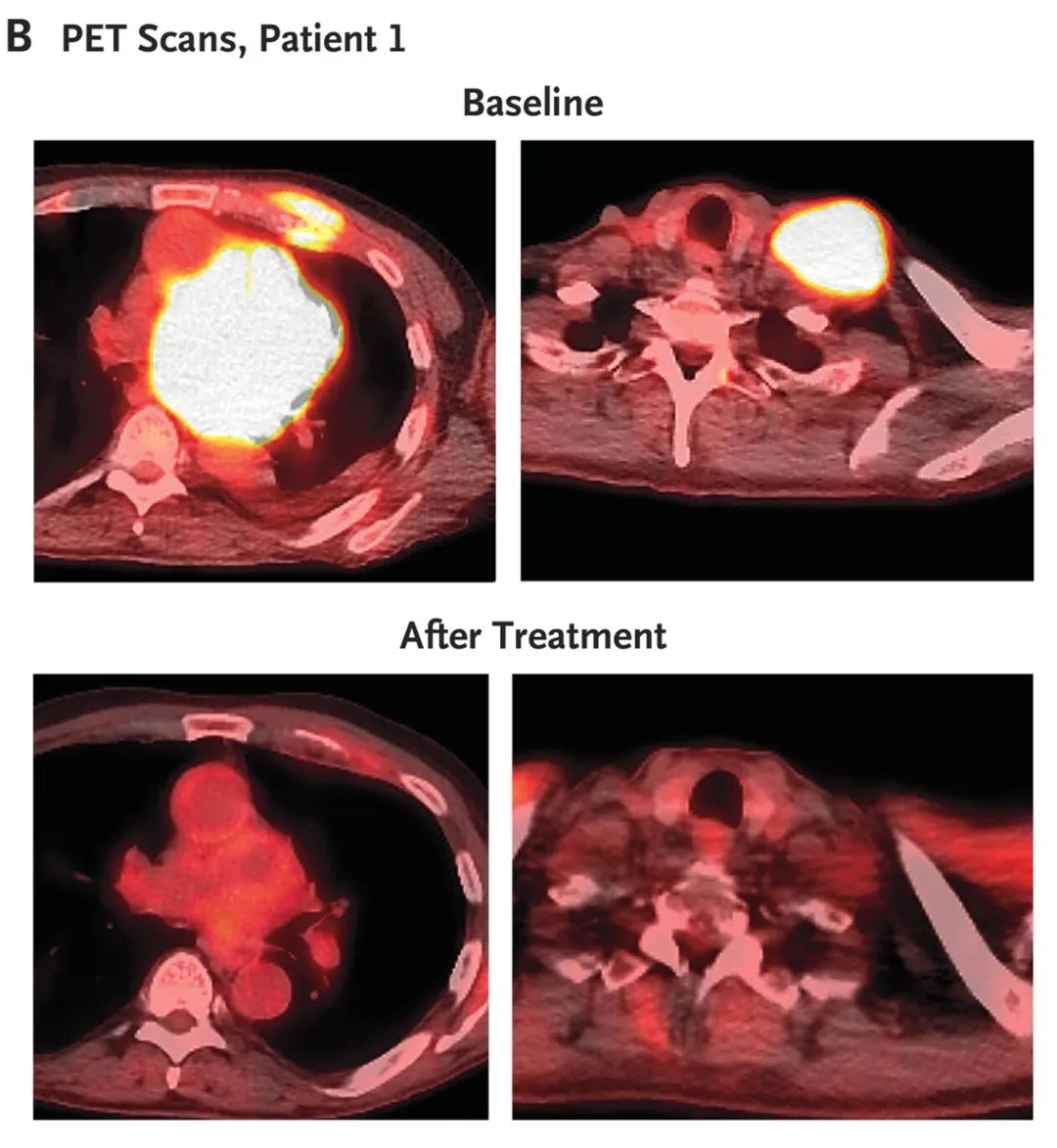GPRC5D CART细胞疗法治疗多发性骨髓瘤的效果