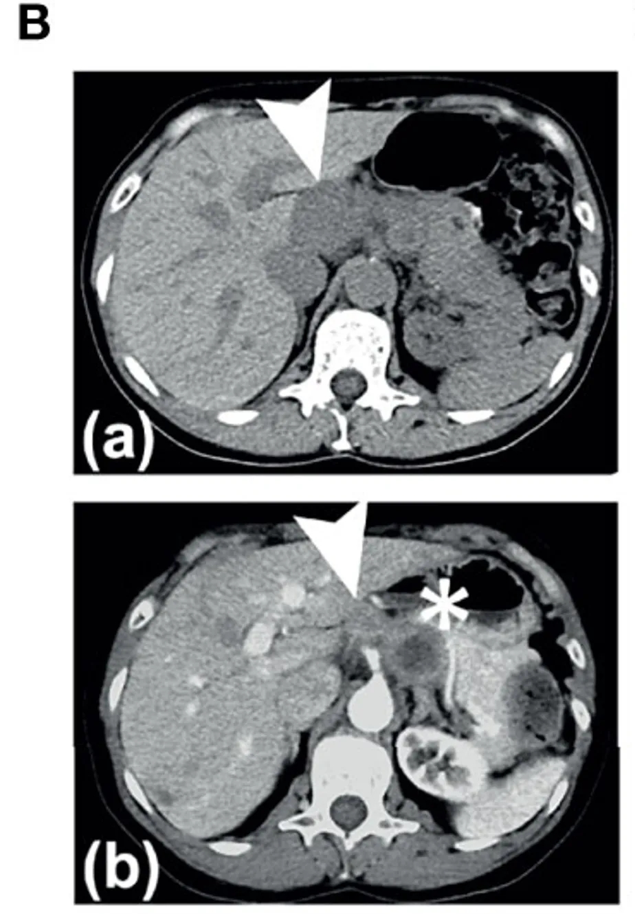 AdHER2 DC疫苗治疗HER2阳性胃癌的效果