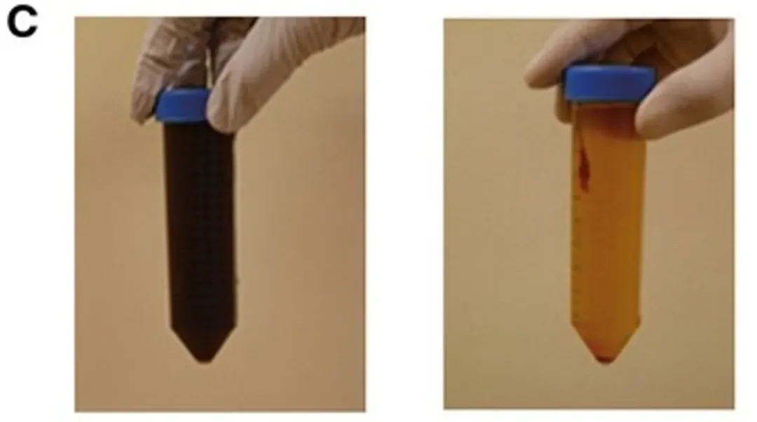 γδT细胞治疗胃癌腹水的效果