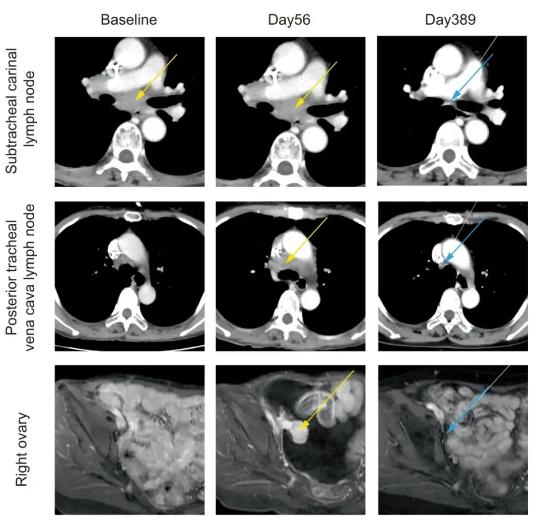 DC疫苗治疗胃癌的效果